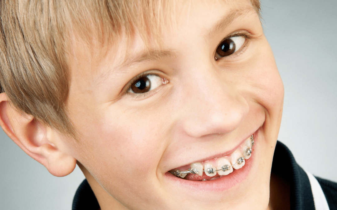 Braces for Children: What Are the Basics?
