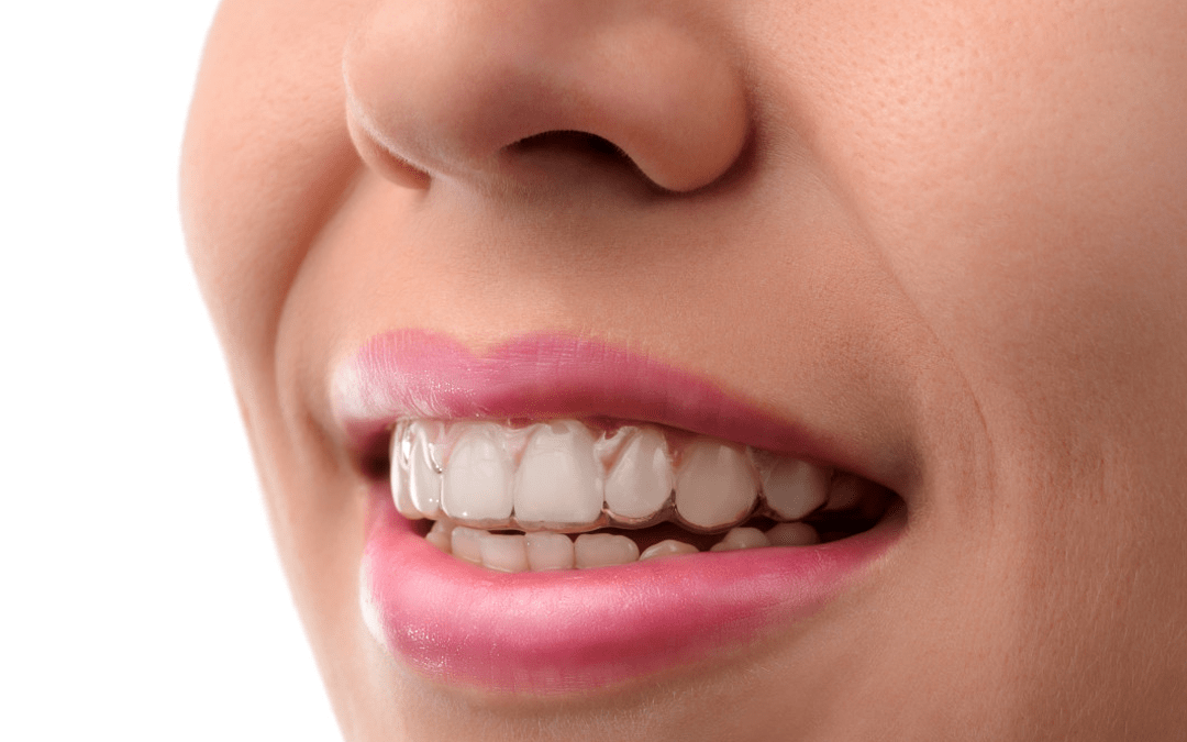 5 Steps To A Straight Smile With Invisalign