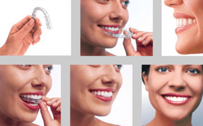 Why Choose Invisalign For Teens