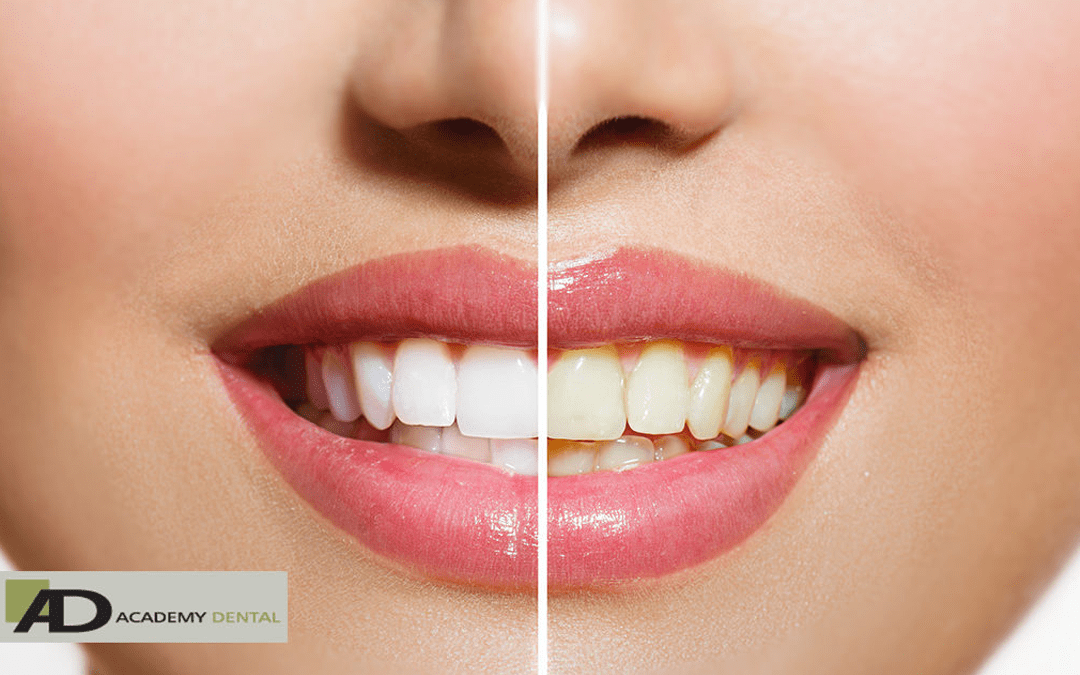 Tips to Prevent Tooth Discoloration After Teeth Whitening