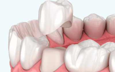 How Much Tooth Structure is Required for a Dental Crown?